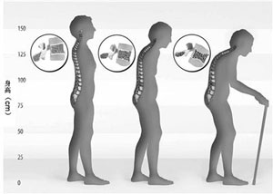 一个人骨骼变形的变化