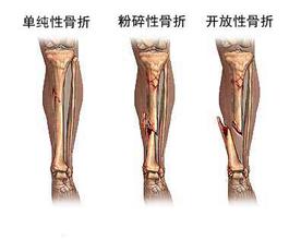 骨折后的骨头