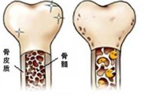 正常的骨头和病变的骨头
