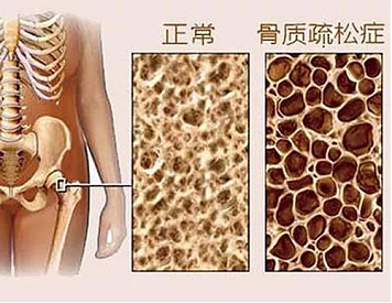 骨质疏松测绿巨人视频app黄色官方下载仪器有哪些种类?不同种类的特点对比